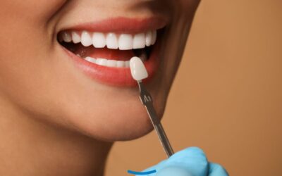 Faccette in ceramica o in composito: differenze, costi e durata